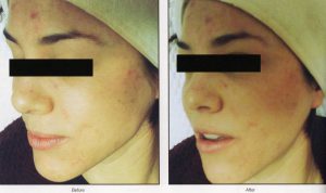 023 - Elmira Studio Before and after photos of a woman with acne.