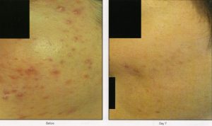 024 - Elmira Studio Acne scars before and after treatment.