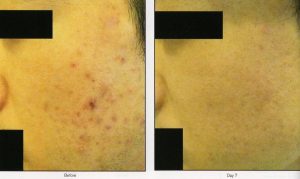 025 - Elmira Studio Acne scars before and after treatment.