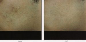 026 - Elmira Studio A person's skin before and after treatment.