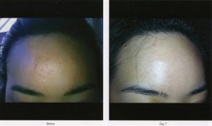 Before and after photos of a woman's skin.