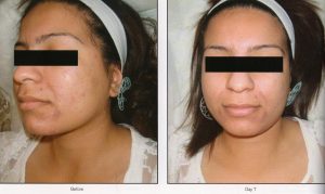 04 - Elmira Studio Before and after photos of a woman with acne.