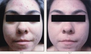 05 - Elmira Studio A woman's face with acne before and after treatment.