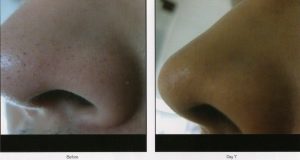 06 - Elmira Studio A person's nose before and after treatment.