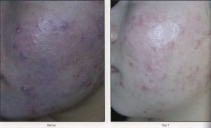 07 - Elmira Studio A woman's face with acne before and after treatment.