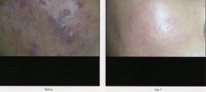 08 - Elmira Studio Psoriasis before and after treatment.