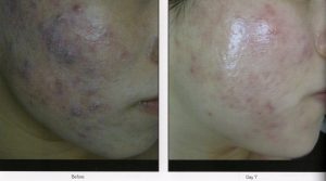 A woman's face with acne before and after treatment.