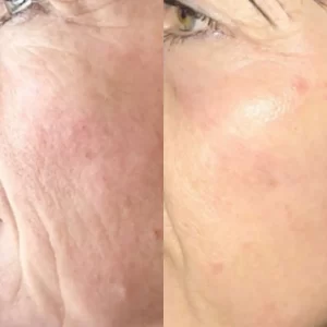A woman with wrinkles before and after treatment.