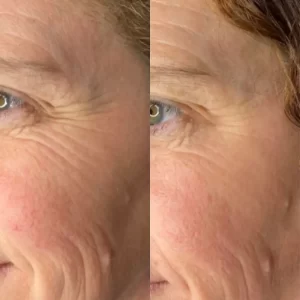 A woman with wrinkles before and after treatment.