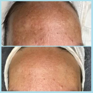 A woman's skin before and after a laser treatment.