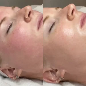 Two pictures of a woman getting a facial treatment.