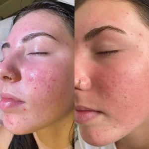 Two pictures of a woman with acne on her face.