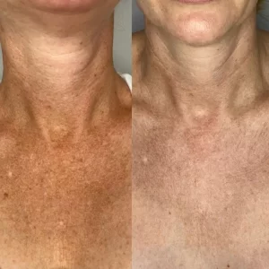 Before and after photo of a woman's neck.
