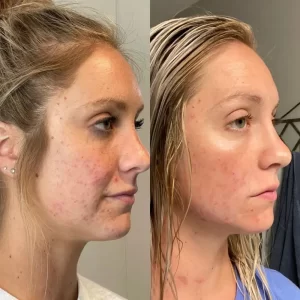 Before and after photos of a woman with acne.