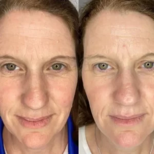 Before and after photos of a woman's face.
