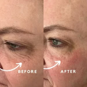 A woman's face with wrinkles before and after treatment.