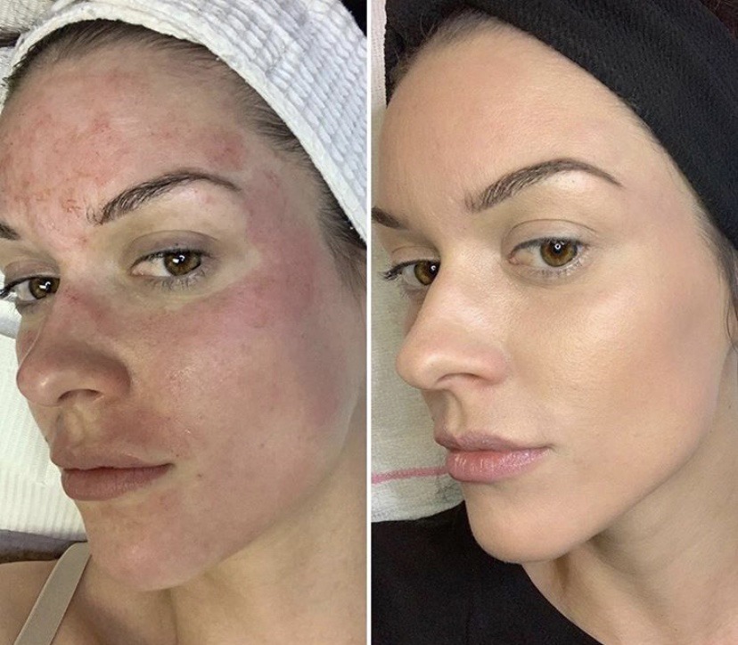 File_000 - Elmira Studio Before and after photos of a woman with acne.