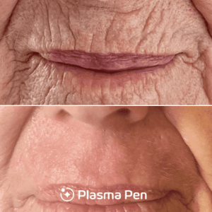 Pisma pen before and after.