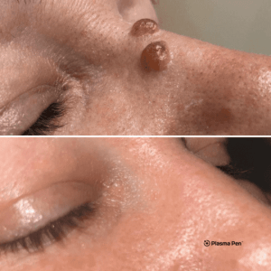 Before and after photos of a woman's nose.