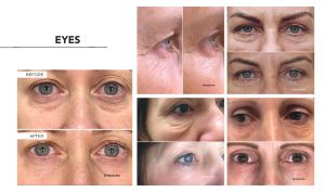 A woman's eyes are shown before and after treatment.