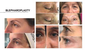Blepharoplasty before and after pictures.
