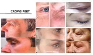 Crow's feet treatment before and after.