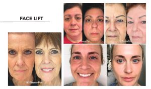 A woman's face lift before and after.