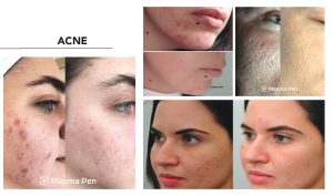 A woman's face before and after acne treatment.
