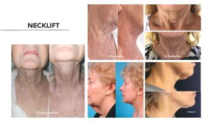 A woman's neck before and after a necklift.