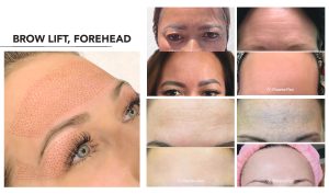 A woman's brow lift before and after.