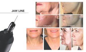 A woman's face is shown before and after using the jaw line.