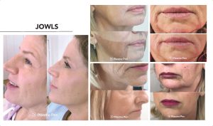 A woman's face before and after a jowls treatment.