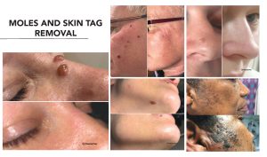 Moles and skin tag removal.