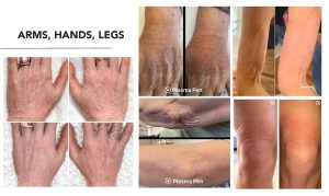 A series of photos showing the treatment of arms, hands, and legs.