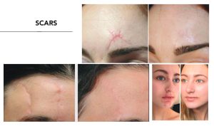 A woman's face with scars before and after treatment.
