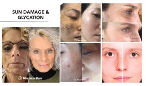Sun damage & glycation treatment.