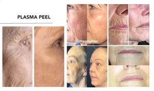 A woman's face before and after a plasma peel.