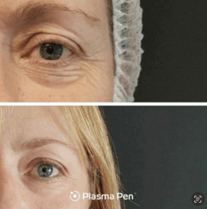 Before and after pictures of a woman's eyes.