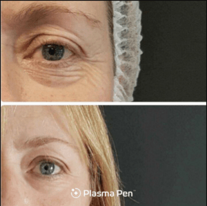 Before and after pictures of a woman's eyes.