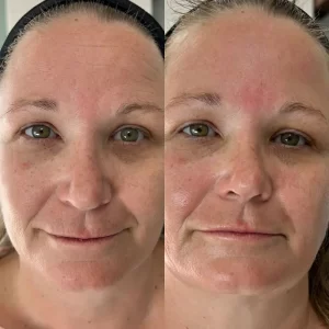 Before and after photos of a woman's face.
