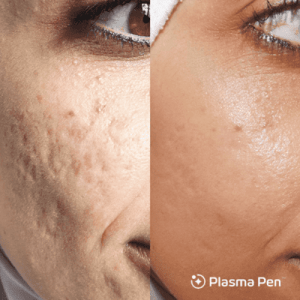 Two pictures of a woman with acne before and after treatment.