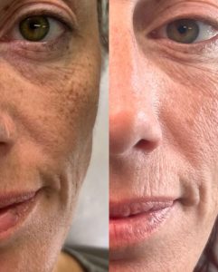 elmirastudio_posts_44 - Elmira Studio Before and after photos of a woman with freckles.