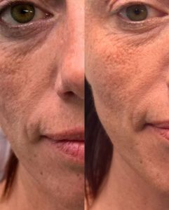 elmirastudio_posts_45 - Elmira Studio Before and after photos of a woman with freckles.