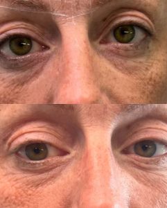 elmirastudio_posts_46 - Elmira Studio Before and after photo of a woman's eyes.