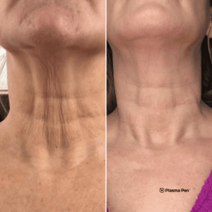 A woman's neck before and after a neck lift.