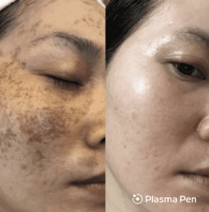 A woman's skin before and after a treatment.