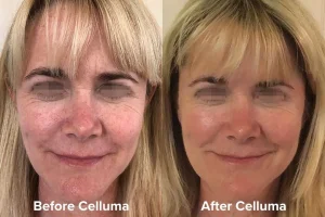 Aging_B_A_Female_Full_Face_Reduced_redness_Images_courtesy_of_Carol_Minger_LAc_1080_x_720px_1556e10c-dca2-4e8f-a671-5c5761801e51 - Elmira Studio