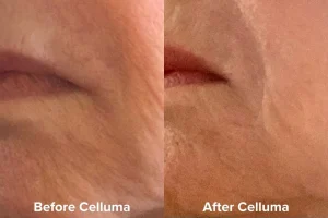 Aging_B_A_Female_Lip_Area_1080_x_720px_15a16922-2d84-4fd0-bfb7-5dd4b53d1ecb - Elmira Studio