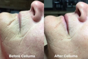 Aging_B_A_Female_Mouth_Area_Images_courtesy_of_Lori_Hall_LE_1080_x_720px_81cef453-c059-46af-b9db-e287d7aebce3 - Elmira Studio