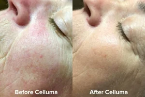 Aging_B_A_Female_Side_Cheek_Images_courtesy_of_Lori_Hall_LE_1080_x_720px_a32eca34-80c6-463e-a603-a987c8b30be9 - Elmira Studio